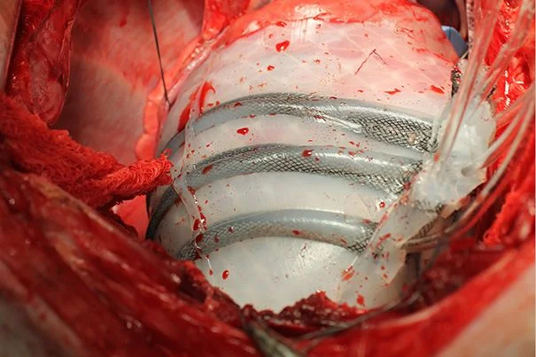Soft robotic sleeve supports heart function